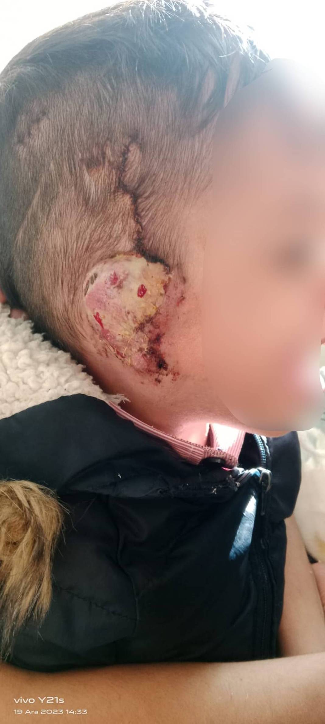 Ameliyat olan 4 yaşındaki çocuğun kulağı çürüdü! 'Operasyonlar güzel geçti diye bizi oyaladılar' 1